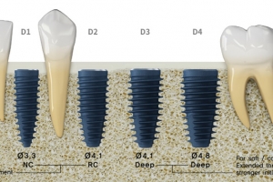 MEGAGEN BD IMPLANT ø4.8